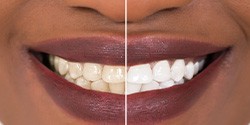 Patient's smile before and after teeth whitening