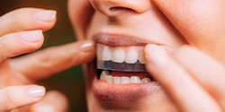 Closeup of patient putting on whitening strip