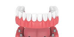 Model of implant-supported denture