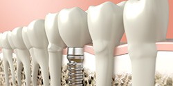 Digital illustration of a dental implant