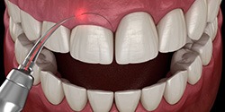 Illustration of laser being used for gummy smile treatment